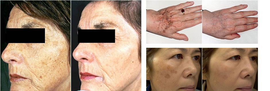 IPL Skin Rejuvenation