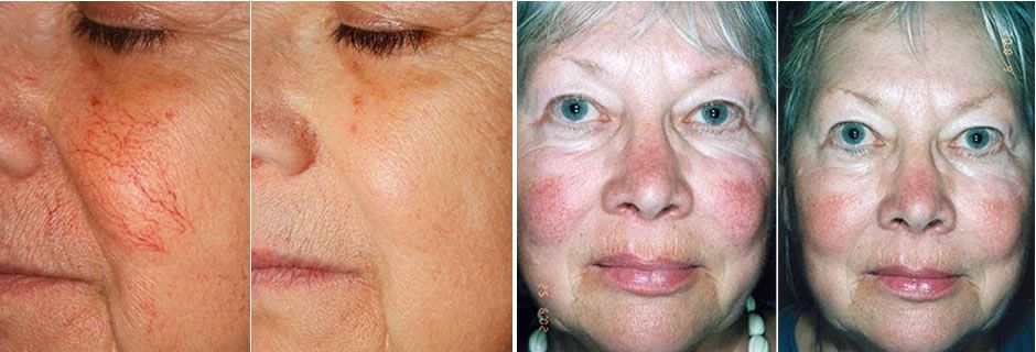 Ellipse IPL Thread Vein